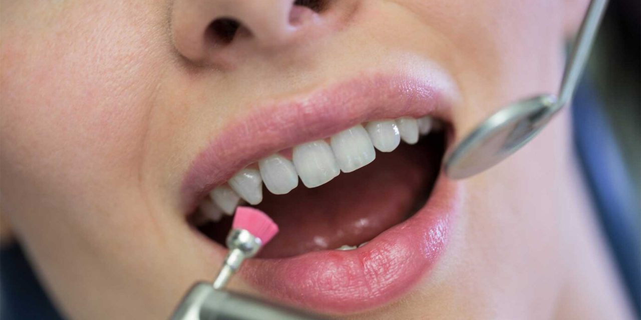 بلیچینگ دندان : روشی برای سفید کردن و زیبایی دندان‌ها