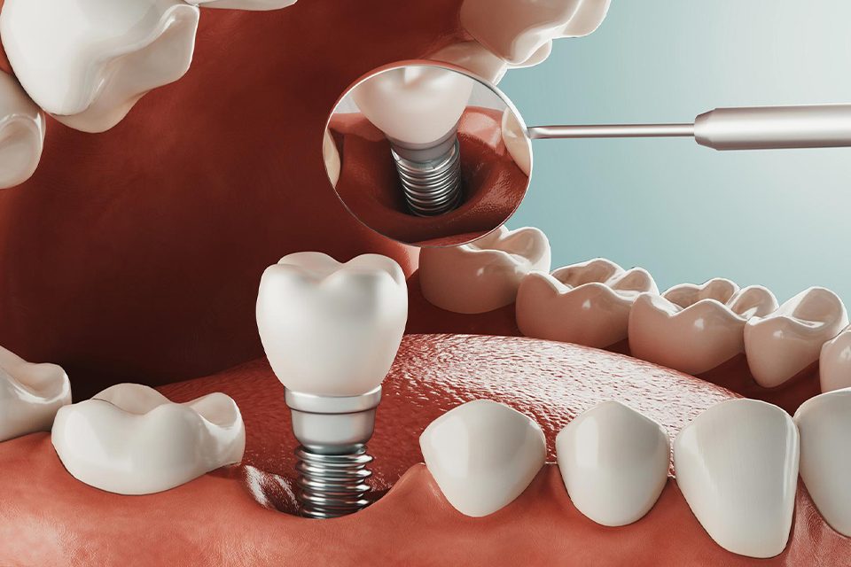 بهترین سنین برای ایمپلنت دندان