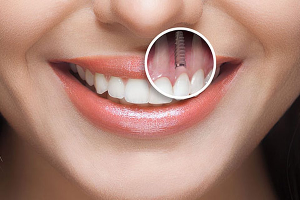ایمپلنت دندان از کجا میاد؟